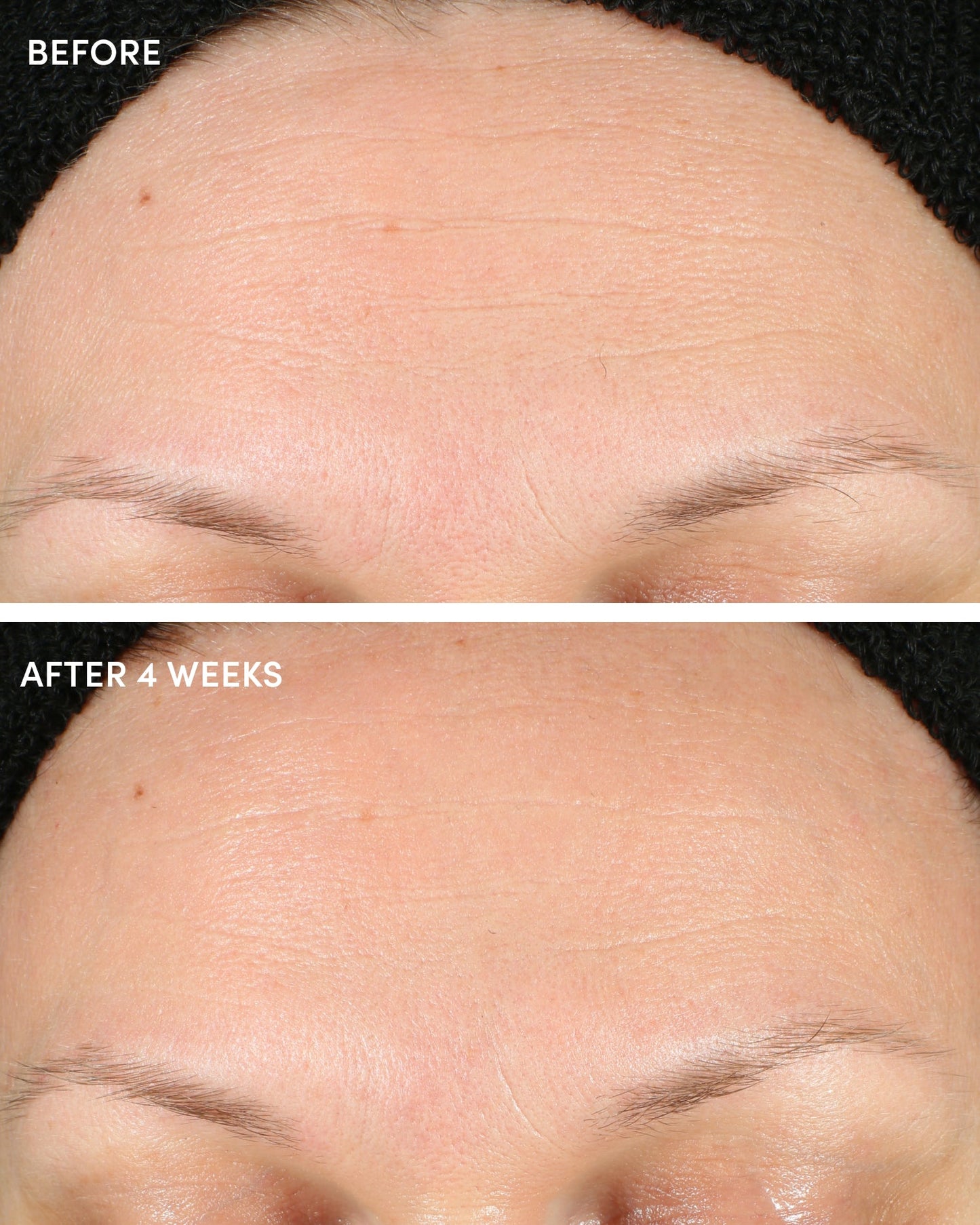 Forehead before and after using for 4 weeks. 